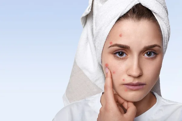 ACNE SCAR TREATMENT