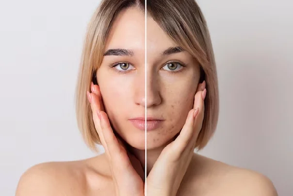 PIGMENTATION TREATMENT