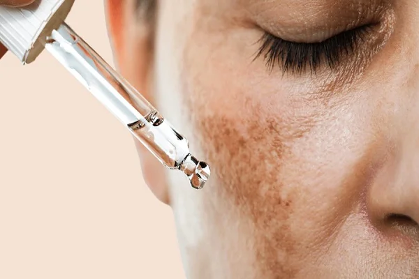 MELASMA TREATMENT